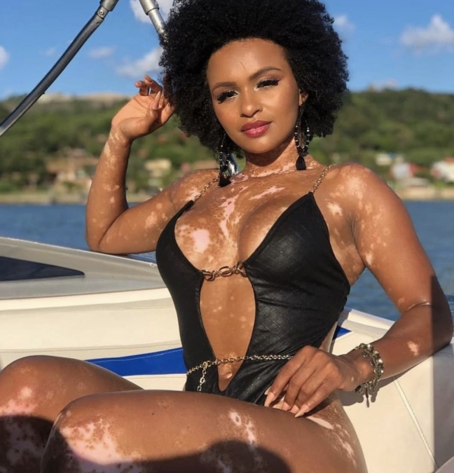 ‘Vitiligo: o maior dano é o causado pelo preconceito’