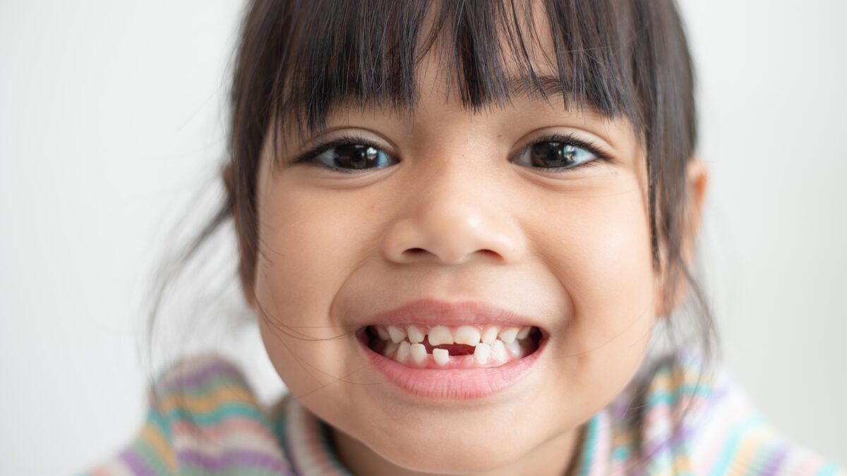 Existe forma correta de extrair dente de leite? Entenda