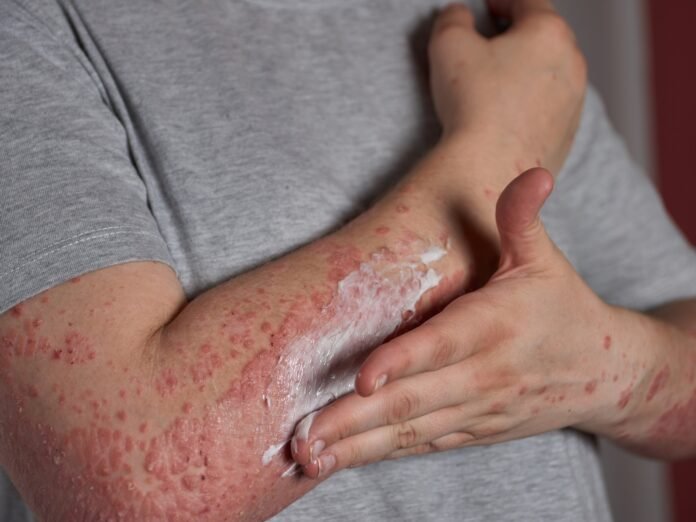 29.10. Psoríase. Foto Divulgação IgesDF